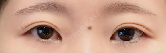 目尻切開 / タレ目形成・グラマラスライン（切開） プロミス整形外科 BEFORE メイン用