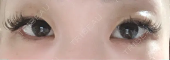 二重切開 / 目頭切開 ばん皮膚科 BEFORE メイン用