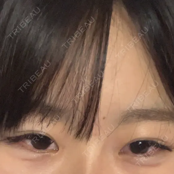目頭切開 HAAB×DREAM BEAUTY CLINIC 大阪梅田院 BEFORE メイン用