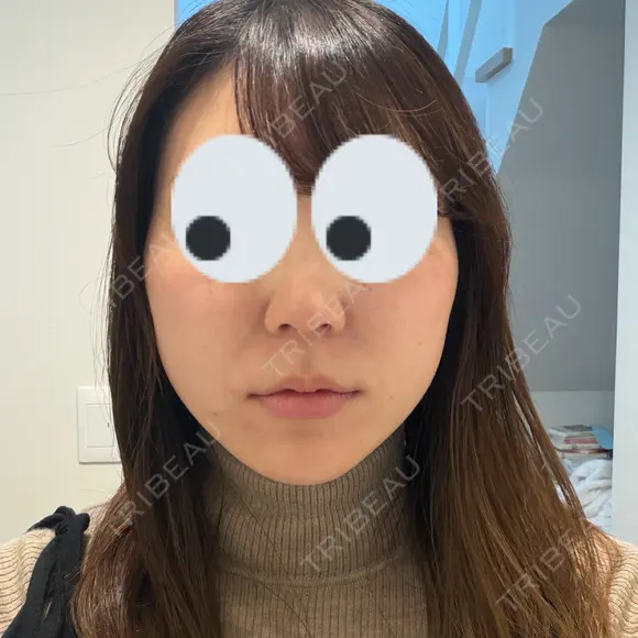 ルメッカ ルラ美容クリニック 札幌本院 BEFORE メイン用