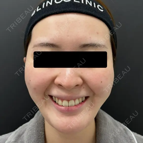 糸リフト / 脂肪吸引（顔） / メーラーファット除去 / ジョールファット除去 BLINC CLINIC （ブリンク クリニック） BEFORE メイン用
