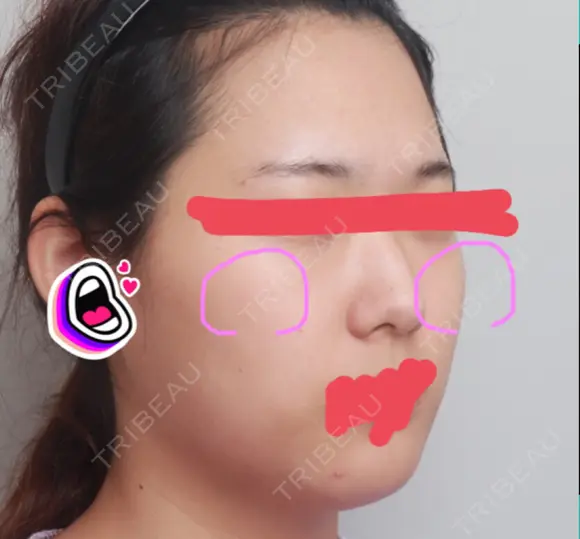 骨削り（頬） RG整形外科（旧リオン整形外科） BEFORE メイン用