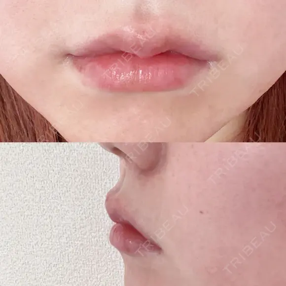 ヒアルロン酸注入（唇） ルラ美容クリニック 仙台院 / ルラスキンクリニック 仙台院 BEFORE メイン用