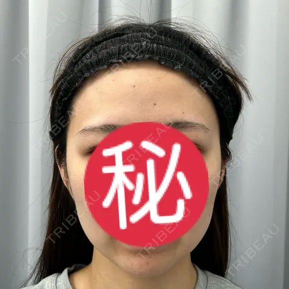 LDM・インテンスウルトラ / デンシティ 湘南美容クリニック 大阪梅田本院 BEFORE メイン用