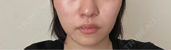 RF（高周波）たるみ治療 / インモード ライブリークリニック 大阪院 BEFORE メイン用