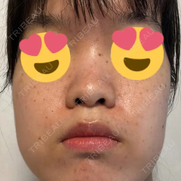 ピーリング（ニキビ・毛穴） ルラ美容クリニック 池袋院 BEFORE メイン用