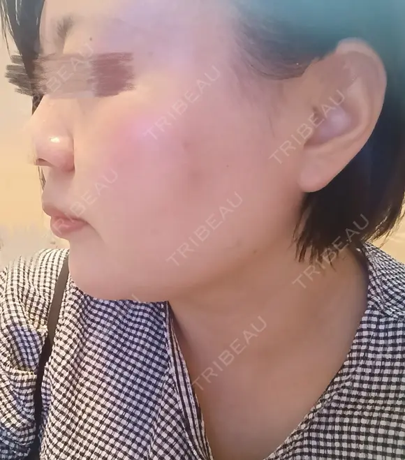 脂肪溶解注射（顔） 上野注入クリニック BEFORE メイン用