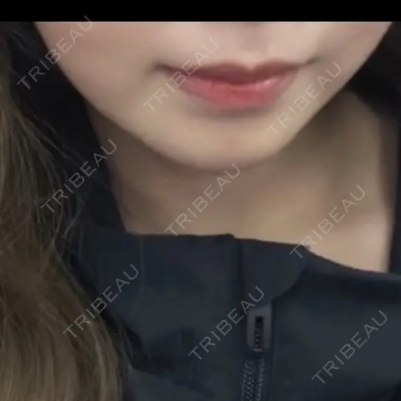 ヒアルロン酸注入（あご） HAAB BEAUTY CLINIC 名古屋院 BEFORE メイン用
