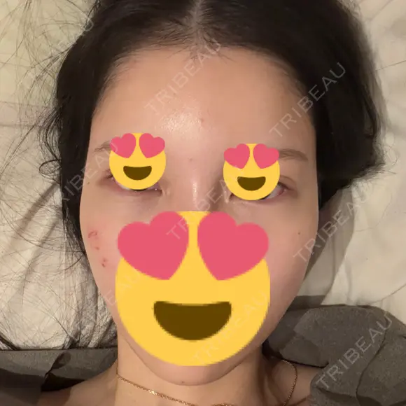 ヒアルロン酸注入（涙袋） / ヒアルロン酸注入（頬） / ヒアルロン酸注入（こめかみ） PRISM Beauty Clinic 新宿院 BEFORE メイン用