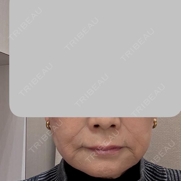 糸リフト 銀座美容外科クリニック 銀座院 BEFORE メイン用