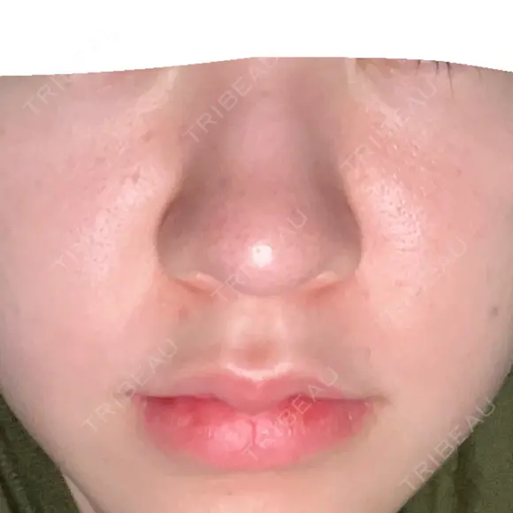 ピーリング（ニキビ・毛穴） / 光治療（フォトフェイシャルなど） / ピーリング（ハリ・ツヤ） DAILY SKIN CLINIC 新宿院 BEFORE メイン用
