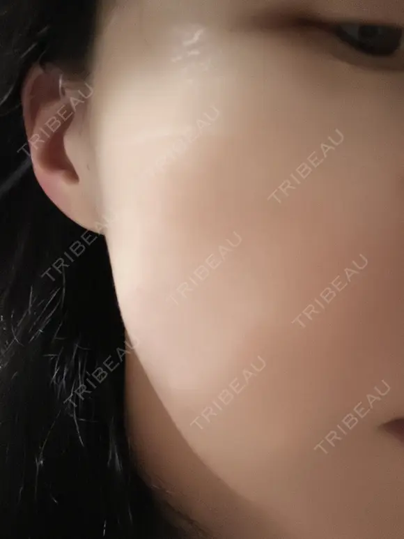 ルメッカ ルラ美容クリニック 新潟院 BEFORE メイン用