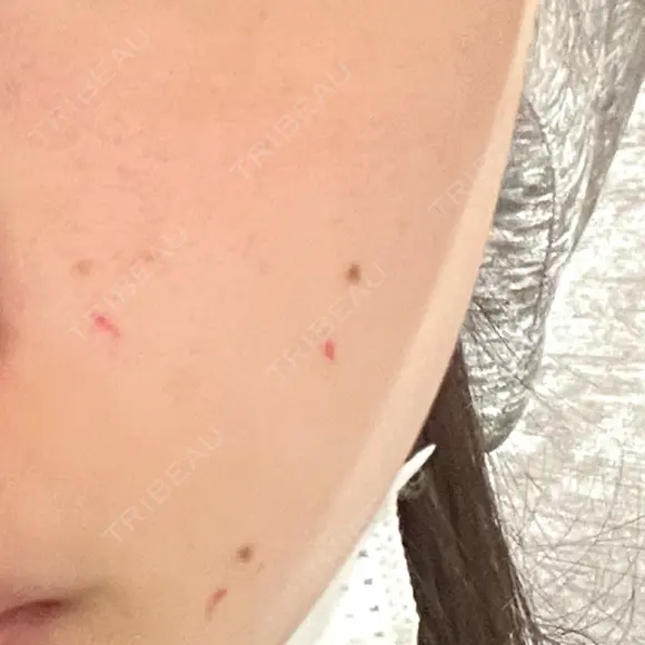 ほくろ・いぼ切除（肌） 美容皮膚科エルムクリニック 大阪院 BEFORE メイン用