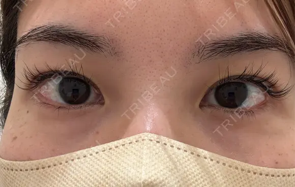 自然癒着法 eクリニック 那覇院 BEFORE メイン用