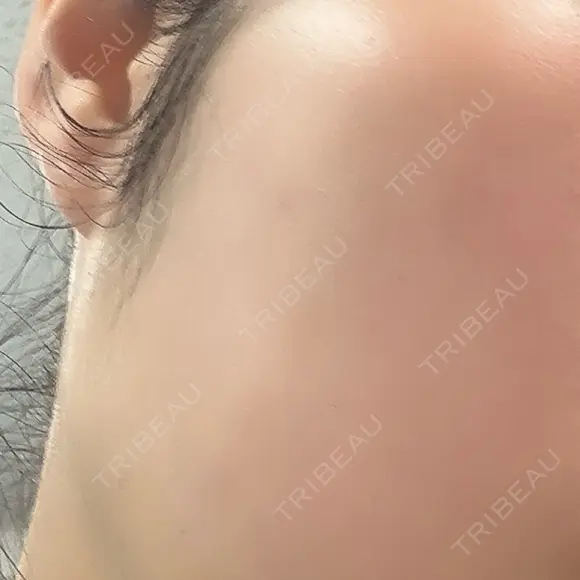 エレクトロポレーション G MEDICAL ART クリニック 表参道院 BEFORE メイン用