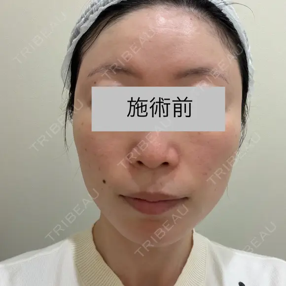 白玉点滴・注射 / ピコレーザートーニング（美白・肝斑） ライズワン美容皮膚科クリニック BEFORE メイン用