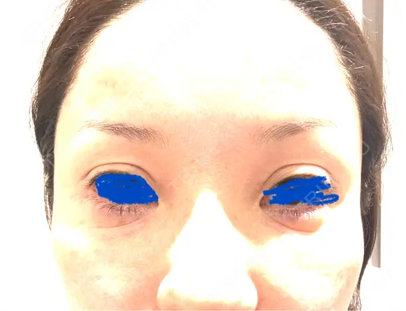 タレ目形成・グラマラスライン（埋没） Zetith Beauty Clinic 銀座院 BEFORE メイン用