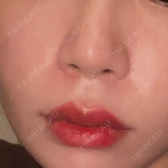 美肌レーザー / レーザーフェイシャル / 赤み除去レーザー AI Beauty Clinic （エーアイ美容クリニック） BEFORE メイン用