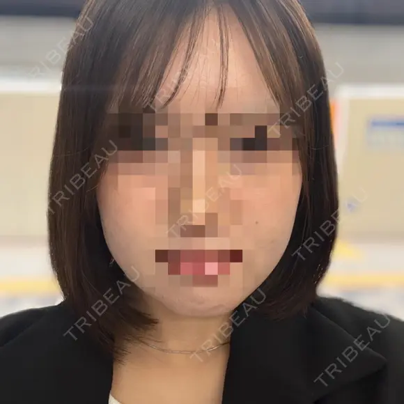 ボトックス（エラ・小顔） AYANAフィラーズクリニック 渋谷院 BEFORE メイン用