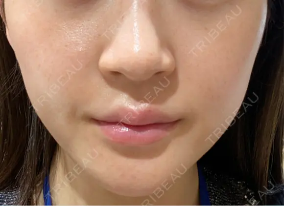 シミ取りレーザー / LDM・インテンスウルトラ Wi Clinic （ウィ クリニック）心斎橋院 BEFORE メイン用