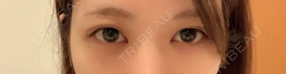 二重埋没 あきこクリニック BEFORE メイン用