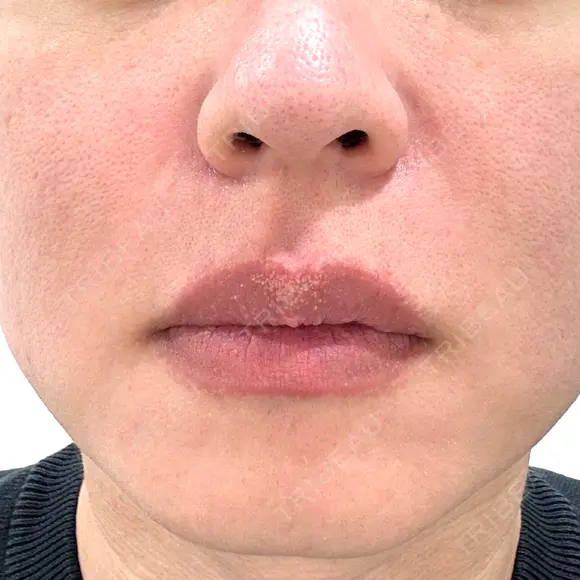 肌育注射（ジュベルックなど） / ニードルRF（ポテンツァなど） PureMe Skin Clinic（ピュアミースキンクリニック麻布） BEFORE メイン用