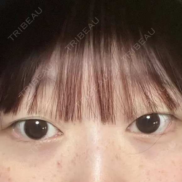二重埋没 アリエル美容クリニック 郡山院 BEFORE メイン用