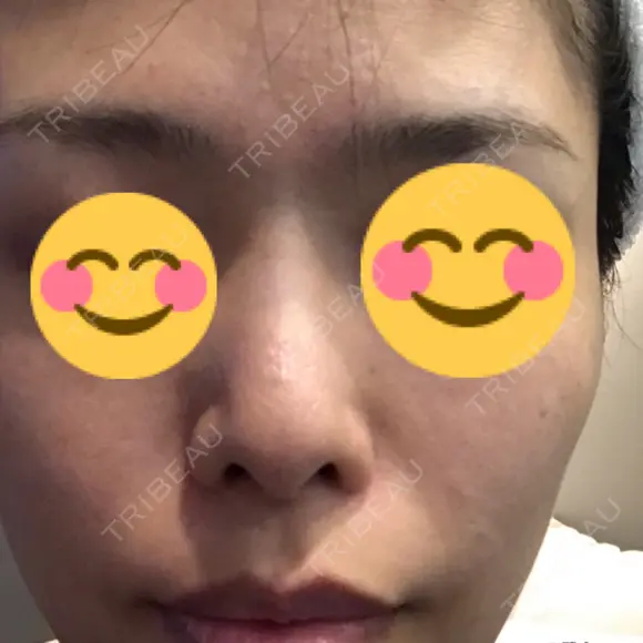 隆鼻術 / 鼻中隔延長（切開） View美容整形外科 BEFORE メイン用