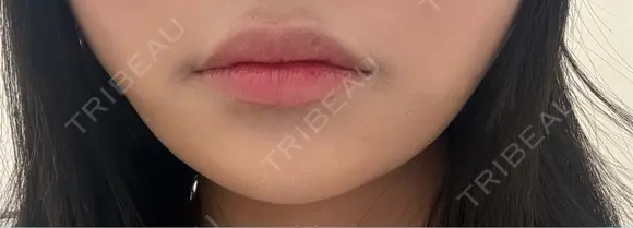 ヒアルロン酸注入（唇） Moon Beauty Clinic BEFORE メイン用