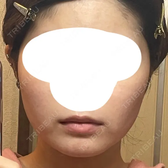 インモード 小倉美容外科/美容皮膚科 ビラビューティークリニック BEFORE メイン用