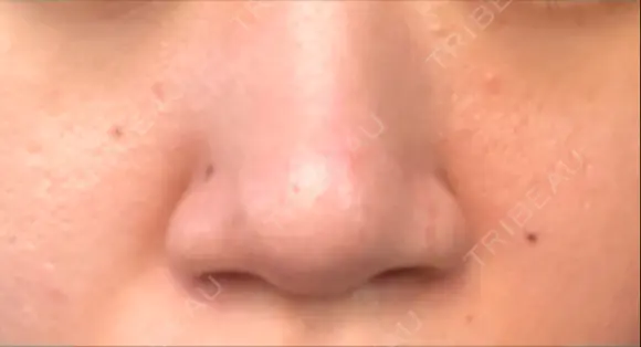 鼻尖形成（切開） / 小鼻縮小（切開） / ヒアルロン酸注入（鼻） 東京ヒルズクリニック 新宿院 BEFORE メイン用