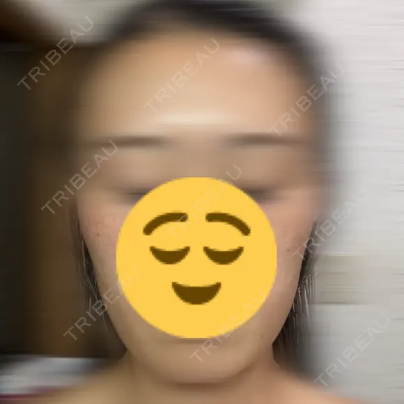 脂肪溶解注射（顔） 新宿美容外科クリニック 新宿院 BEFORE メイン用