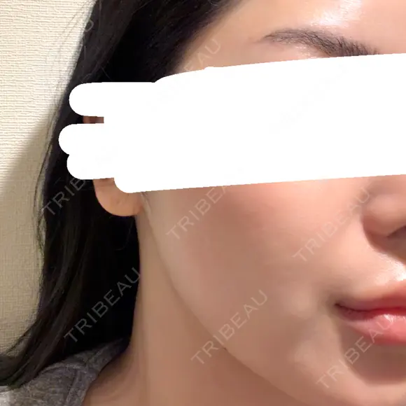 水光注射（ハリ・美肌） BISIN GINZA CLINIC BEFORE メイン用