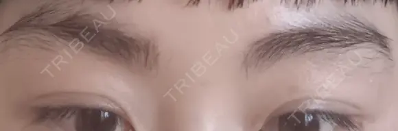 ボトックス（眉間） 高崎TAクリニック BEFORE メイン用