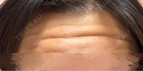 ボトックス（額） 神戸スイミー皮膚科美容外科 BEFORE メイン用