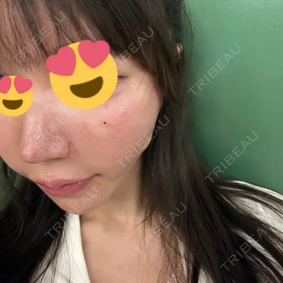 イオン導入 コントアクリニック 東京 BEFORE メイン用