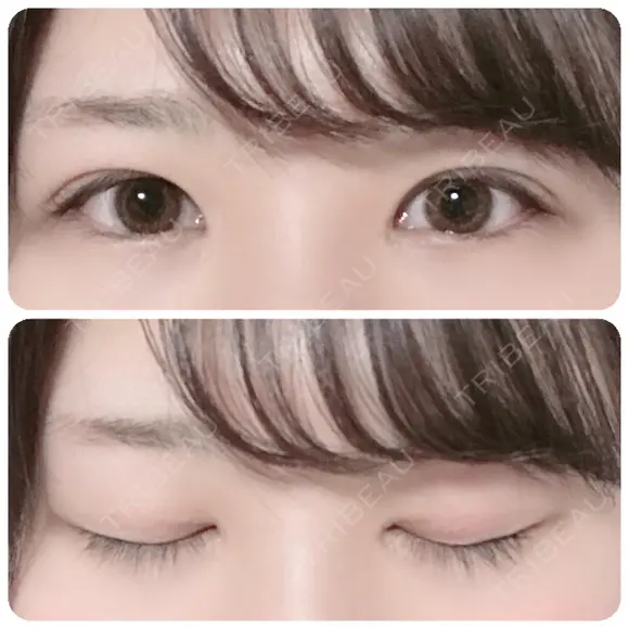 二重切開 / 上まぶたの脂肪取り 太田西ノ内病院 BEFORE メイン用