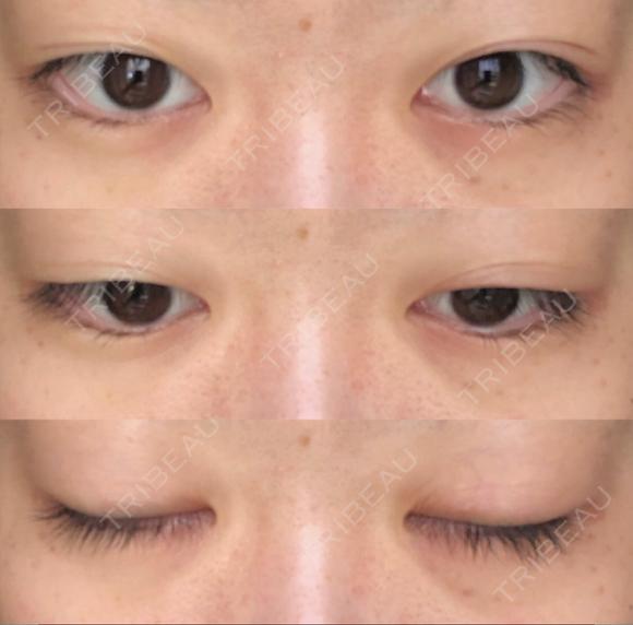 眼瞼下垂（切開） / その他（目元） / 目尻切開 / 自然癒着法 POP美容整形クリニック BEFORE メイン用