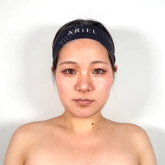糸リフト / バッカルファット除去 / 脂肪吸引（顔） / ボトックス（口角） / ボトックス（首） アリエル美容クリニック 水戸院 BEFORE メイン用