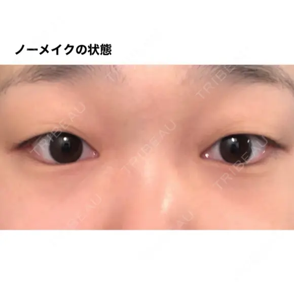 二重埋没 湘南美容クリニック 福島院 BEFORE メイン用
