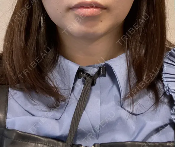 オンダリフト RIVER CLINIC（リバークリニック） BEFORE メイン用