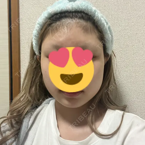 糸リフト / 脂肪吸引（顔） / ボトックス（エラ・小顔） PRISM Beauty Clinic 町田院 BEFORE メイン用
