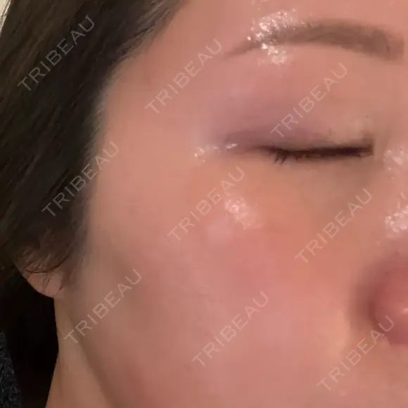 ピーリング（ハリ・ツヤ） BISIN GINZA CLINIC BEFORE メイン用
