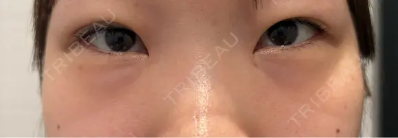 下まぶたの脂肪取り R Beauty CLINIC 名古屋院 BEFORE メイン用