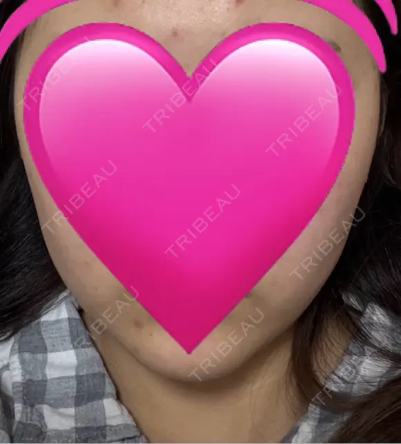 インモード ARTE BEAUTY CLINIC BEFORE メイン用