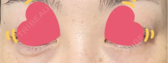 ヒアルロン酸注入（涙袋） PRO CLINIC プロクリニック 銀座院 BEFORE メイン用