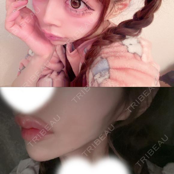 糸リフト / 水光注射（ハリ・美肌） ルラ美容クリニック 岡山院 BEFORE メイン用