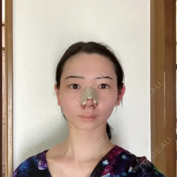 鼻尖形成（切開） / 小鼻縮小（切開） / 軟骨移植 / 鼻尖縮小 / 鼻孔縁下降 アリエル美容クリニック 郡山院 BEFORE メイン用