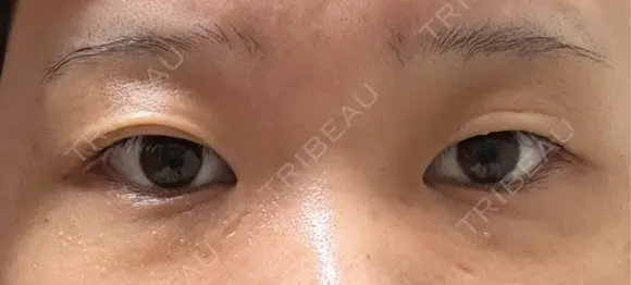 自然癒着法 / ヒアルロン酸注入（涙袋） CLINIC W BEFORE メイン用