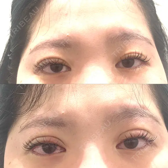 二重埋没 HAAB×DREAM BEAUTY CLINIC 大阪梅田院 BEFORE メイン用